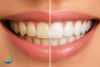 بلیچینگ بهتر است یا کامپوزیت؟ مقایسه کامل مزایا، معایب، ماندگاری و هزینه‌ها